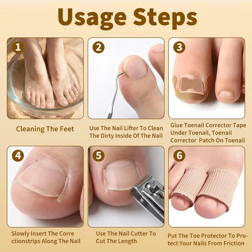 Miniatura 7 de Juego de corrector de uñas encarnadas con tiras correctoras y lima sin dolor, kit profesional de eliminación de uñas encarnadas con herramienta