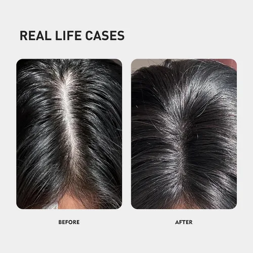 Miniatura 3 de KINTOR 0.5% KX-826 Spray para el crecimiento del cabello DHT bloqueador Productos de recrecimiento del cabello, nutre los folículos pilosos