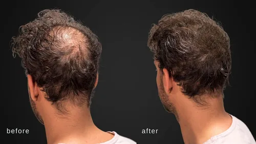 Miniatura 4 de Fibras capilares voluminizadoras con queratina real para adelgazar el cabello/pérdida de cabello – Dermatológicamente probado y certificado