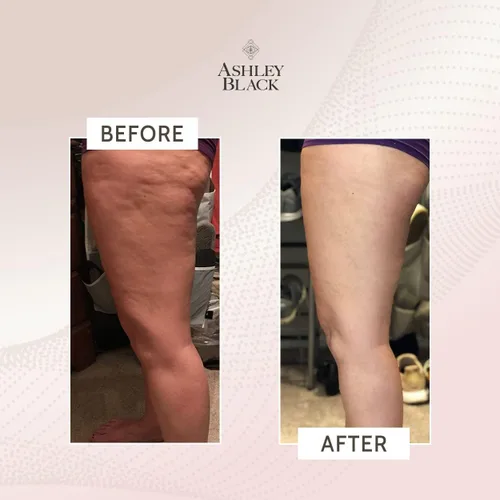 Miniatura 3 de FasciaBlaster El ProBlaster de Mano de Ashley Black. Herramientas MioFasciales Científicamente Probadas. Masaje Suave con Resultados Efectivos.