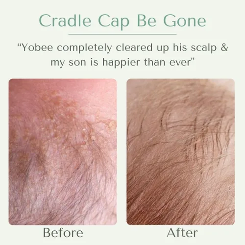Miniatura 2 de Yobee Máscara calmante ultra suave para el cuero cabelludo, tratamiento del cuero cabelludo seco, mascarilla para el cabello segura para la piel