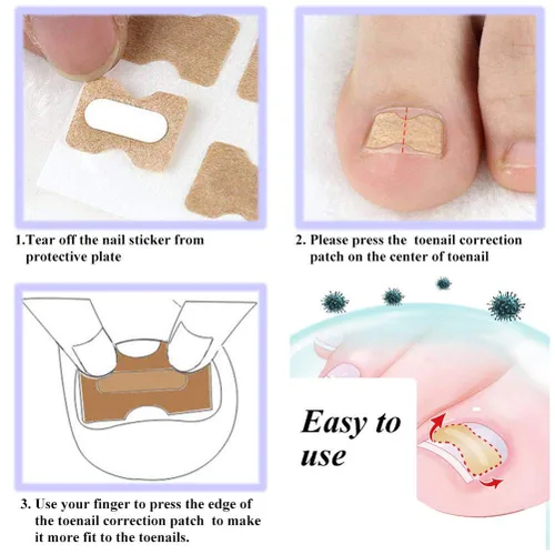 Miniatura 5 de Parche de corrección de uñas encarnadas, 50 calcomanías de uñas encarnadas sin pegamento para uñas encarnadas curvadas para el cuidado de los pies