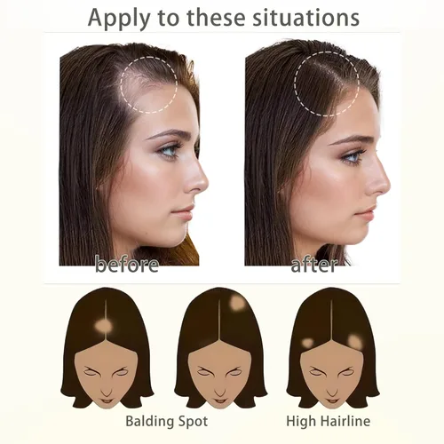 Miniatura 7 de Reemplazo de cabello humano con cicatrices, quemaduras accidentales sin vello para hombres y mujeres, pérdida de línea de cabello, cinta recta