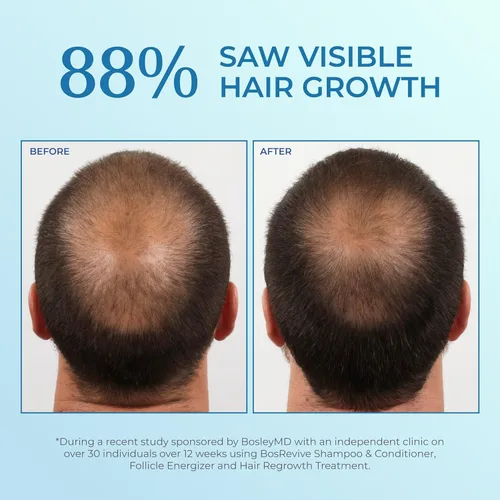Miniatura 3 de BosleyMD Pulverizador Minoxidil sin ensuciar para hombre, extra fuerte, 2 onzas líquidas (2 unidades)
