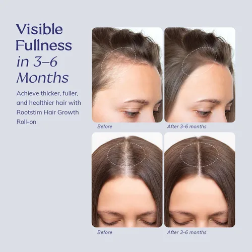 Miniatura 6 de Sérum Roll On para el crecimiento del cabello con romero, cafeína y biotina, ayuda a apoyar el cabello de aspecto más completo, limpia el suero