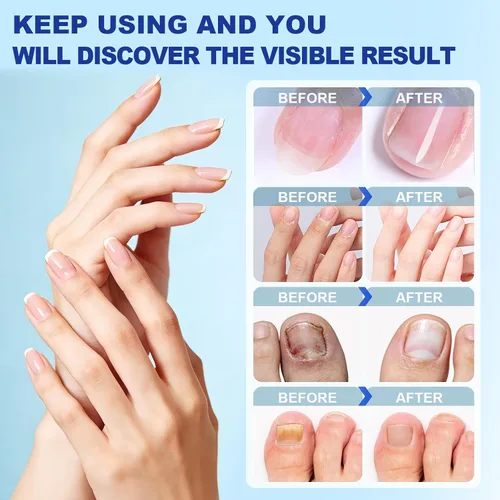 Miniatura 2 de Parches de uñas para uñas de los pies, paquete de 2, calcomanías para uñas de los pies, parches de uñas nocturnas de 8 horas para uñas grandes