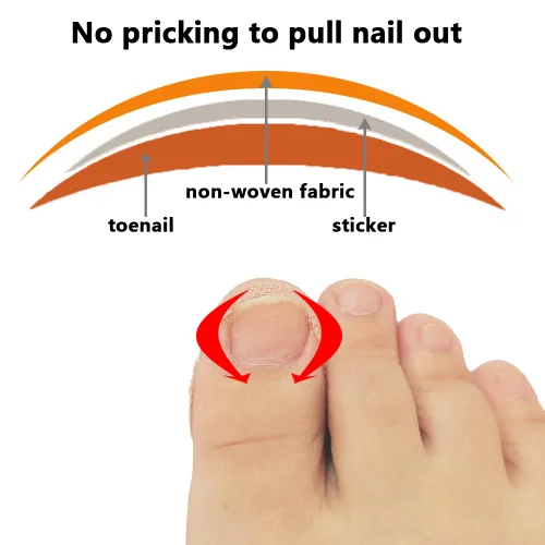 Miniatura 4 de Tratamiento de uñas encarnadas, 50 parches correctores de uñas encarnadas, calcomanías de corrección de uñas de los pies, herramienta profesional