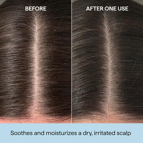Miniatura 2 de Briogeo Scalp Revival Rosemary Pre-Wash Oil Moisturizing Scalp Treatment for Dry, Flaky, or Itchy Scalp Strengthens Hair & Soothes Scalp Vegan