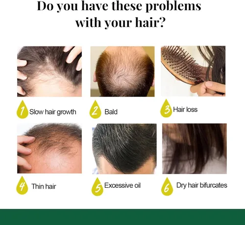 Miniatura 5 de Shouga Kingu Aceite de jengibre para el crecimiento del cabello, aceite germinal de 7 días, control de caída del cabello, tratamiento para cabello