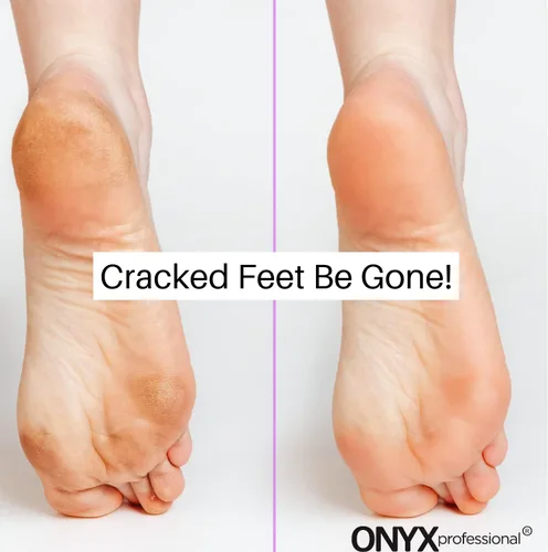 Miniatura 7 de Onyx Professional Calcetines hidratantes de gel, tratamiento de pies secos de talla única para mujeres u hombres, calcetines de spa hidratantes