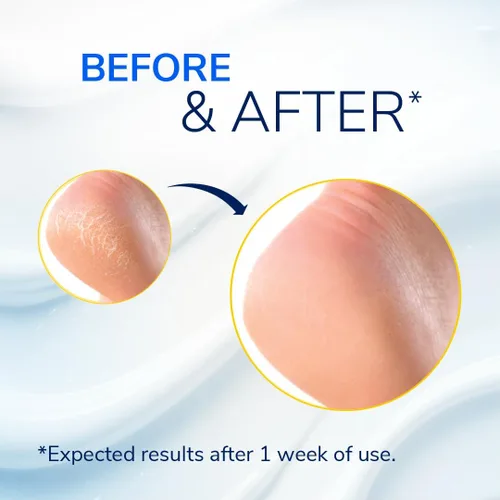 Miniatura 3 de Dr. Scholl's Bálsamo Restaurador para Reparación de Talones Severamente Agrietados 2.5oz, con 25% de urea para pies secos y agrietados, cura e