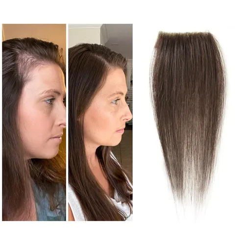 Miniatura 50 de Reemplazo de cabello humano con cicatrices, quemaduras accidentales sin vello para hombres y mujeres, pérdida de línea de cabello, cinta recta