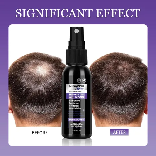 Miniatura 5 de Spray de minoxidil al 5% para tratamiento de crecimiento del cabello, paquete de 2, evita el adelgazamiento, promueve un cabello más fuerte y lleno