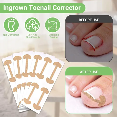 Miniatura 4 de Juego de corrector de uñas encarnadas con tiras correctoras, kit de herramientas profesionales para uñas de los pies, incluye tiras transpirables