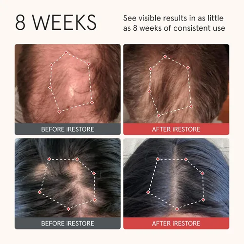 Miniatura 2 de iRESTORE Acondicionador de cabello biotina para cabello seco dañado, bueno para el crecimiento del cabello fino, acondicionador voluminizador