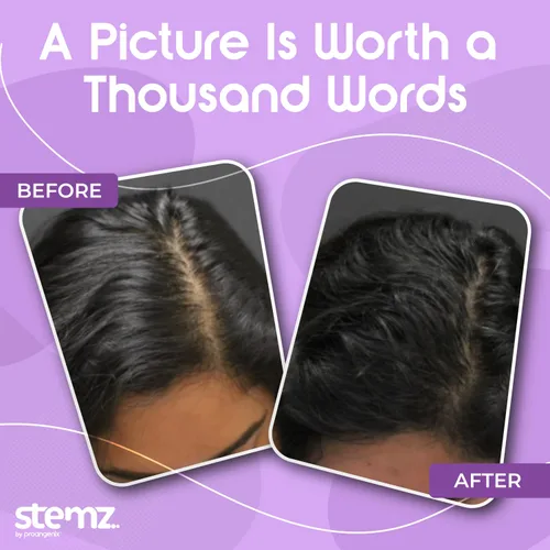 Miniatura 6 de Stemz - Estimulador de folículos pilosos para mujeres, alternativa natural al minoxidil y al aceite de crecimiento del cabello, péptidos de musgo