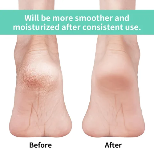 Miniatura 2 de Vaincre - 4 pares de calcetines de gel hidratantes para talones, para pies secos y agrietados en mujeres, cuidado de pies spa, calcetines sin dedos