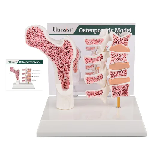 Ultrassist Modelo de anatomía humana de osteoporosis - Modelo seccional de esqueleto de vértebras con tarjeta de estudio para demostración de