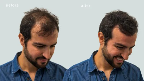 Miniatura 5 de Fibras capilares voluminizadoras con queratina real para adelgazar el cabello/pérdida de cabello – Dermatológicamente probado y certificado