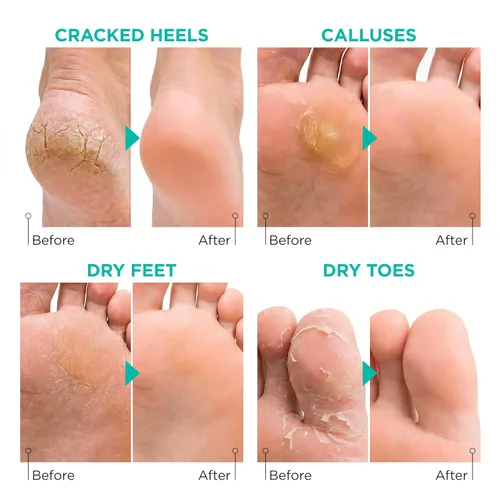 Miniatura 5 de Máscara exfoliante para pies Lavinso para pies secos y agrietados – Paquete de 2 mascarillas exfoliantes que eliminan la piel muerta y callos