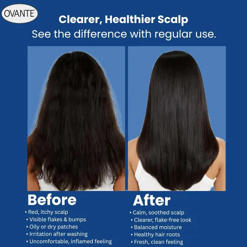 Miniatura 5 de Solución para foliculitis en champú natural, 6 onzas líquidas