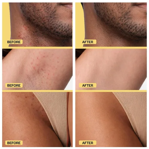 Miniatura 11 de Base Laboratories Tratamiento para el cabello encarnado – Suero Roller – Suero para suavizar la piel para pelos encarnados y protuberancias