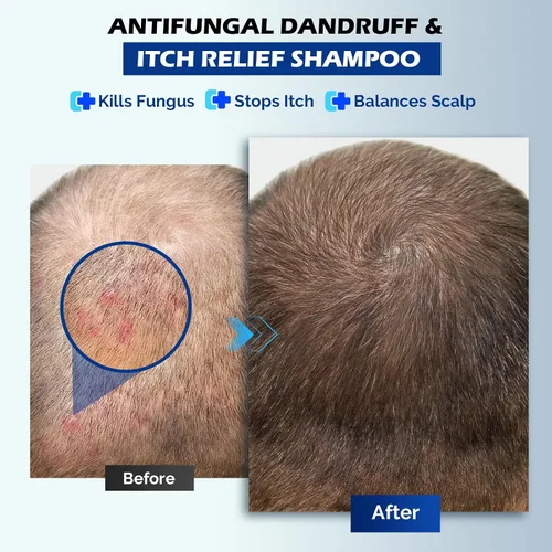 Miniatura 5 de Champú antifúngico para dermatitis seborreica, foliculitis y psoriasis del cuero cabelludo, champú anticaspa para hombres y mujeres, alivia