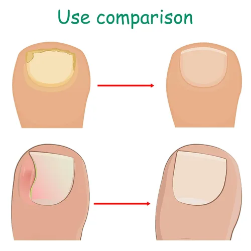 Miniatura 6 de Kit corrector de uñas encarnadas con tiras de corrección flexibles y cinta – Juego de herramientas profesionales de pedicura en el hogar