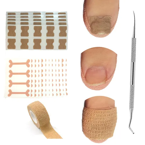 Miniatura 10 de Tratamiento de uñas encarnadas, 50 parches correctores de uñas encarnadas, calcomanías de corrección de uñas de los pies, herramienta profesional