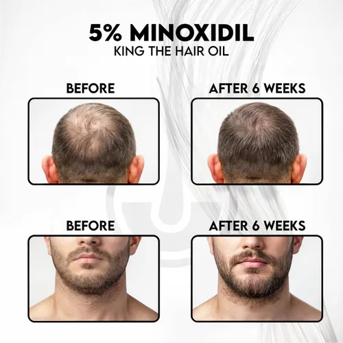 Miniatura 5 de Kings Topical - Fórmula de minoxidil al 5% para hombres sin alcohol, combate el adelgazamiento, el patrón masculino y la pérdida de cabello