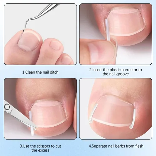 Miniatura 7 de Kits de corrector de uñas encarnadas con tiras curvas, parches transpirables y herramientas de pedicura, juego de cuidado de uñas para una