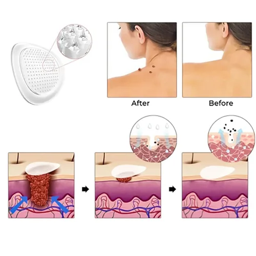Miniatura 2 de KUBOZN Pro MicroDardos Patch, hidrocoloide con ácido salicílico, 144 unidades, cubierta invisible contra manchas (1 caja)