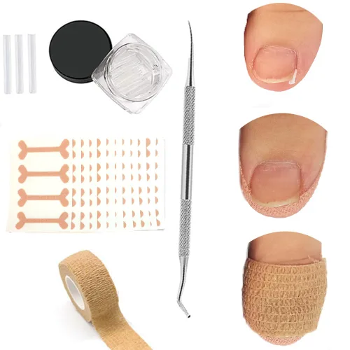 Miniatura 9 de Tratamiento de uñas encarnadas, 50 parches correctores de uñas encarnadas, calcomanías de corrección de uñas de los pies, herramienta profesional