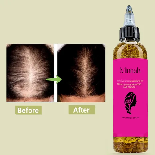Miniatura 4 de Minnah - Aceite de batana para el crecimiento del cabello líquido 4 en 1, 1 unidad Crack Aceite de Crecimiento del Cabello Con Romero, Semilla De