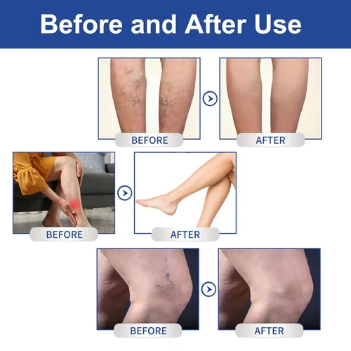 Miniatura 4 de Crema para venas varicosas para piernas, pies y tobillos, crema para el cuidado del edema, mejora la apariencia de la piel y las molestias, alivia