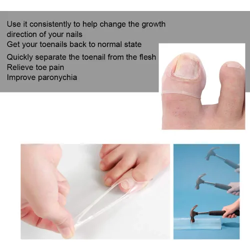 Miniatura 3 de Corrector de uñas encarnadas, 2 piezas de herramienta de corrección de uñas encarnadas de silicona, corrector de uñas encarnadas, tratamiento