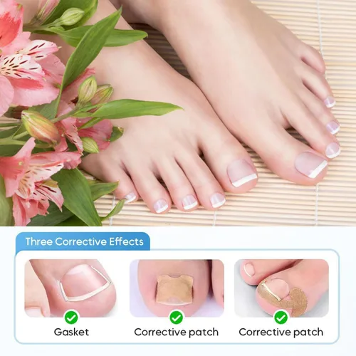 Miniatura 2 de Juego profesional de uñas encarnadas con tiras transpirables de uñas encarnadas, tiras correctoras de uñas de los pies, parche corrector de uñas