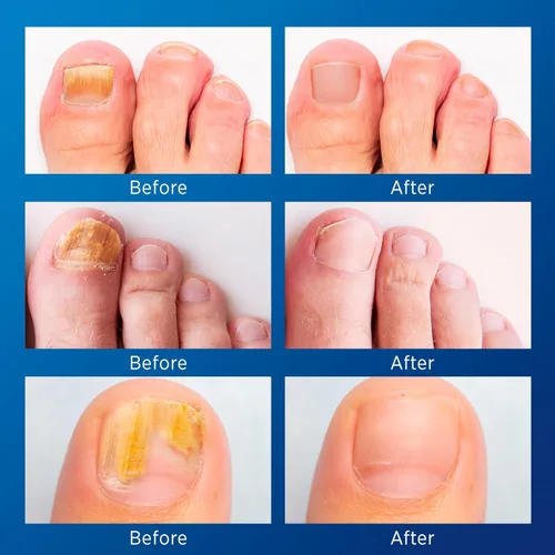 Miniatura 3 de Tratamiento de hongos en las uñas de los pies extra fuerte – Tratamiento de hongos en las uñas para uñas de los pies extra fuerte – Parches