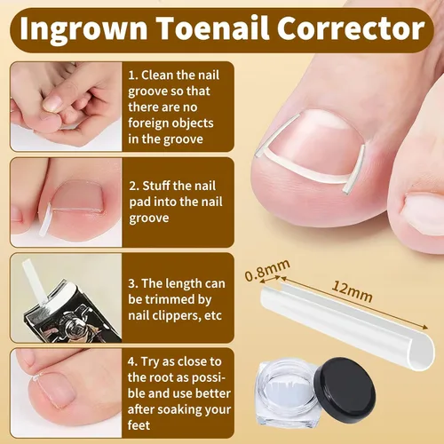 Miniatura 5 de Juego de corrector de uñas encarnadas con tiras correctoras y lima sin dolor, kit profesional de eliminación de uñas encarnadas con herramienta
