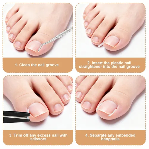 Miniatura 5 de Kit de 16 piezas de uñas encarnadas, con tiras transpirables para uñas de los pies en crecimiento, corrección de dedos curvos, parches de yeso sin