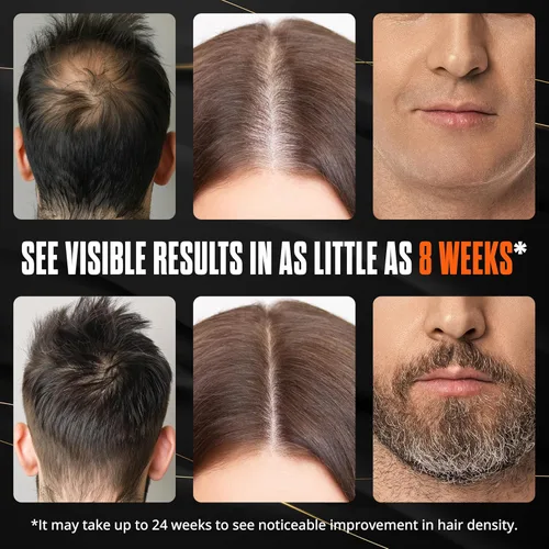 Miniatura 8 de Abera Suero para el crecimiento del cabello para la pérdida del cabello, tratamiento natural para el crecimiento del cabello y la barba con biotina