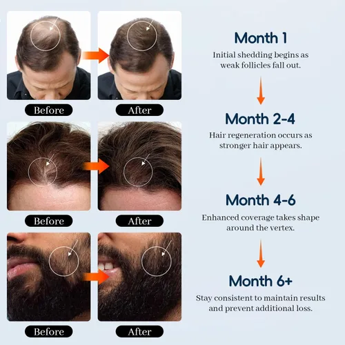 Miniatura 6 de 5% de minoxidil para hombres y mujeres, tratamiento para el crecimiento del cabello y la barba con biotina y romero para adelgazamiento y pérdida