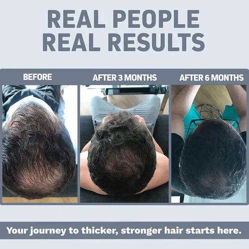 Miniatura 3 de FoliTonic DHT Bloqueador y suplemento de pérdida de cabello Adelgazamiento del cabello y promueve el crecimiento saludable del cabello más grueso