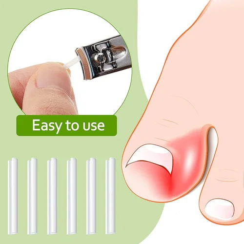 Miniatura 6 de Tiras correctoras de uñas encarnadas profesionales, 50 tiras correctoras de uñas encarnadas, tiras curvadas para enderezar las uñas del pie, clips