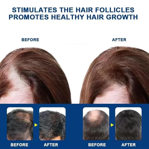 Miniatura 3 de Crema de masaje de cuero cabelludo de minoxidil al 5 % para el crecimiento del cabello, crema de minoxidil profesional, rápido crecimiento y 2 pzas