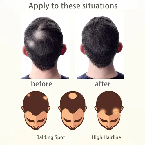 Miniatura 8 de Reemplazo de cabello humano con cicatrices, quemaduras accidentales sin vello para hombres y mujeres, pérdida de línea de cabello, cinta recta