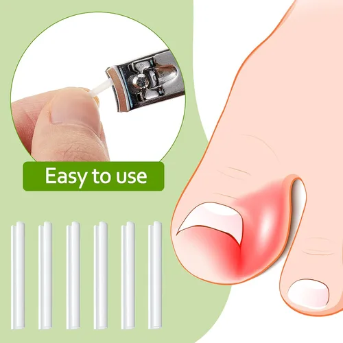 Miniatura 2 de 100 tiras correctoras de uñas encarnadas, parches de corrección de uñas de los pies, parches curvos para enderezar las uñas de los pies, clips
