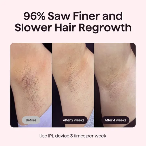 Miniatura 3 de Wavytalk Dispositivo de depilación IPL, Bare It para bikini de cara y cuerpo, resultado duradero y sin dolor, cuerpo completo en 12 minutos