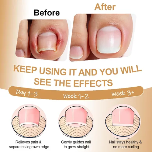 Miniatura 3 de Kit de eliminación y corrector de uñas encarnadas para un alivio rápido del dolor, kit profesional de tratamiento de uñas encarnadas con tiras