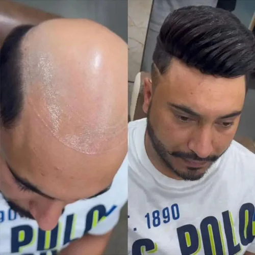 Miniatura 2 de SIMBEAUTY Cabello humano súper natural para hombre, estilo libre de tupé, 10 x 8 pulgadas, sistemas de reemplazo de cabello para hombres